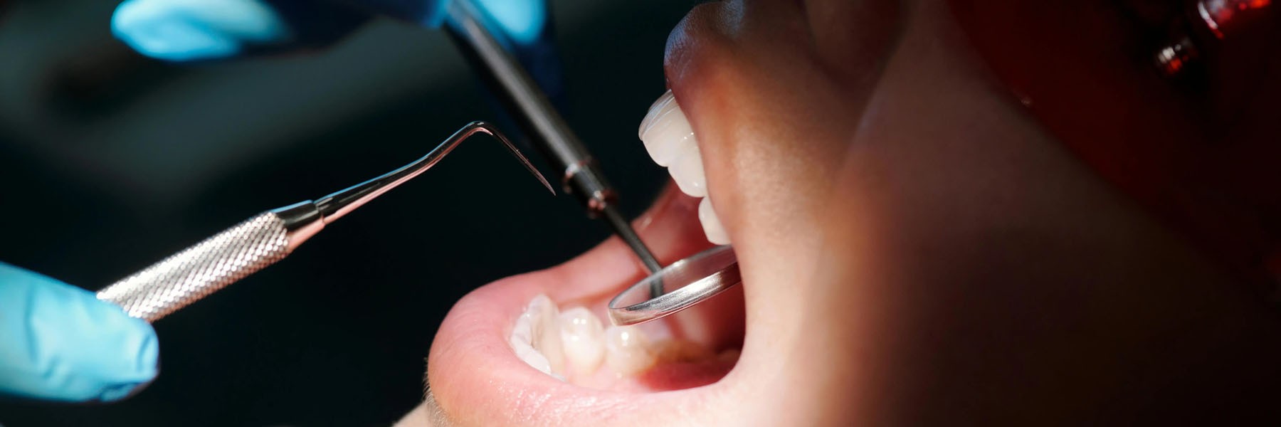 Dental Implant Kits